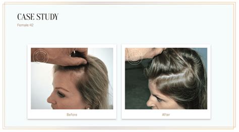 harklinikken student discount|I Tried Harklinikken, the Buzzy Scandinavian Hair .